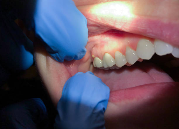Best Broken or Cracked Tooth Emergency Dentist in Crescent City, CA